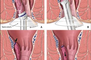 disease-hemorrhoids02-1