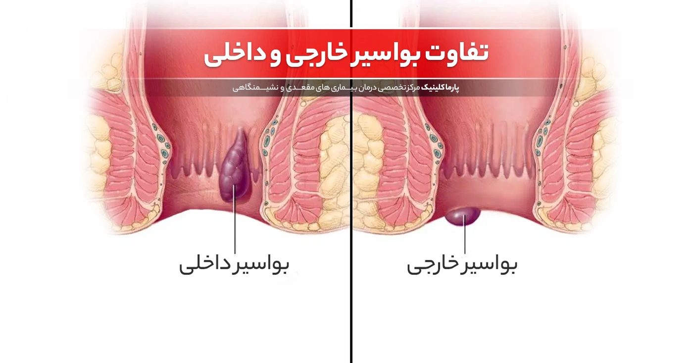 بواسیر داخلی